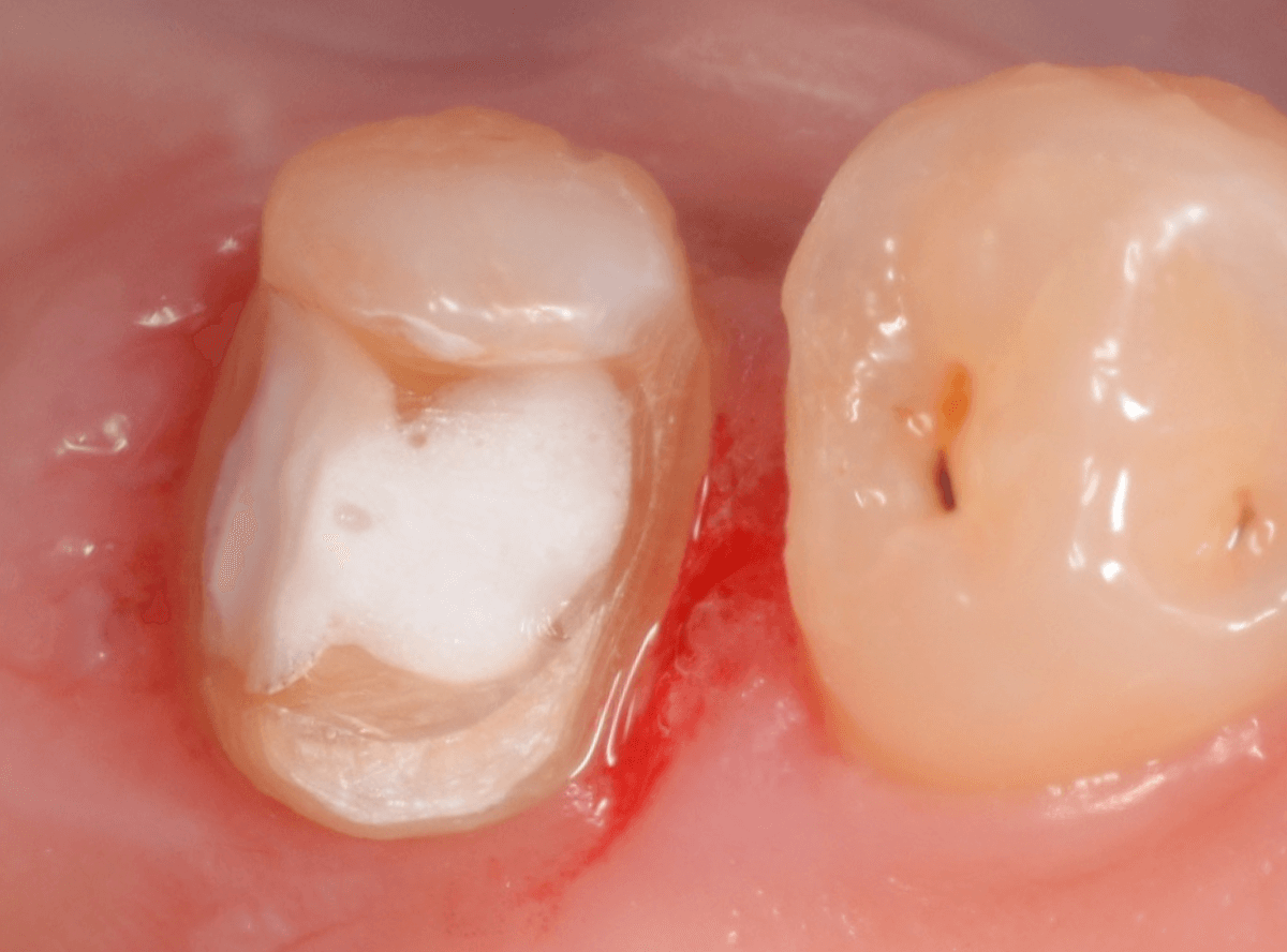 セラミック治療(インレー)14-1