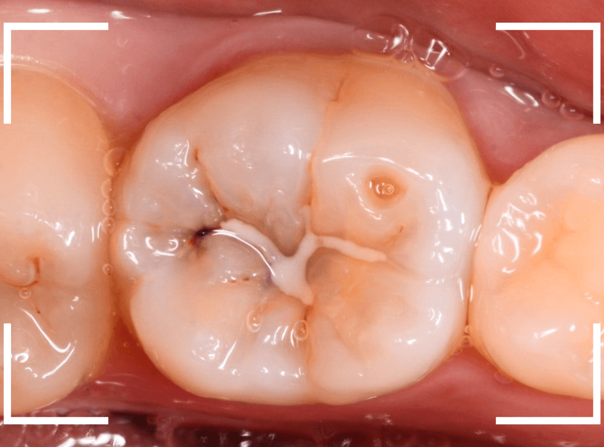小窩裂溝う蝕1-1