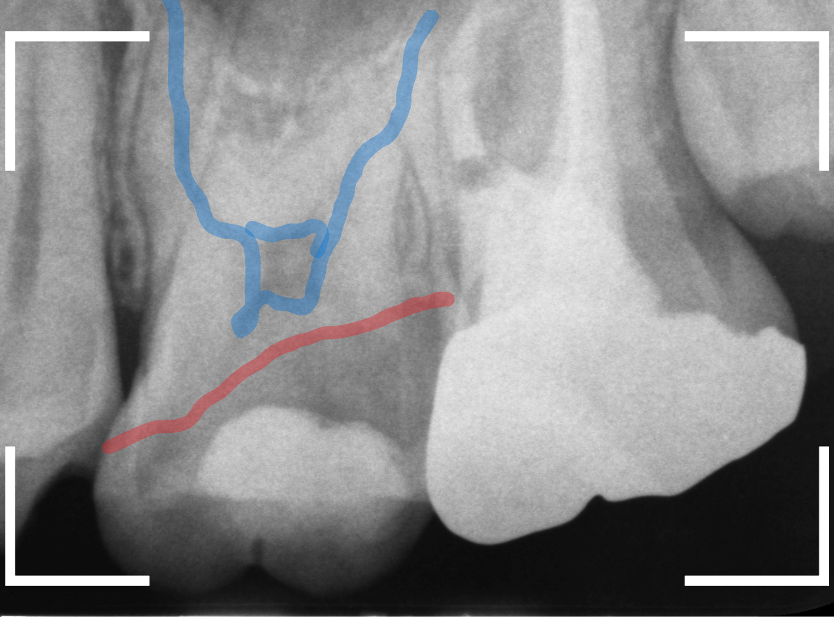 つめものの下の深い深い虫歯20-1