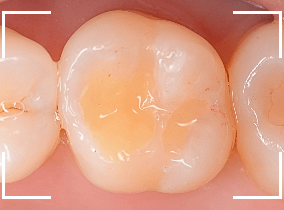 レントゲンでわかりづらい虫歯8-5