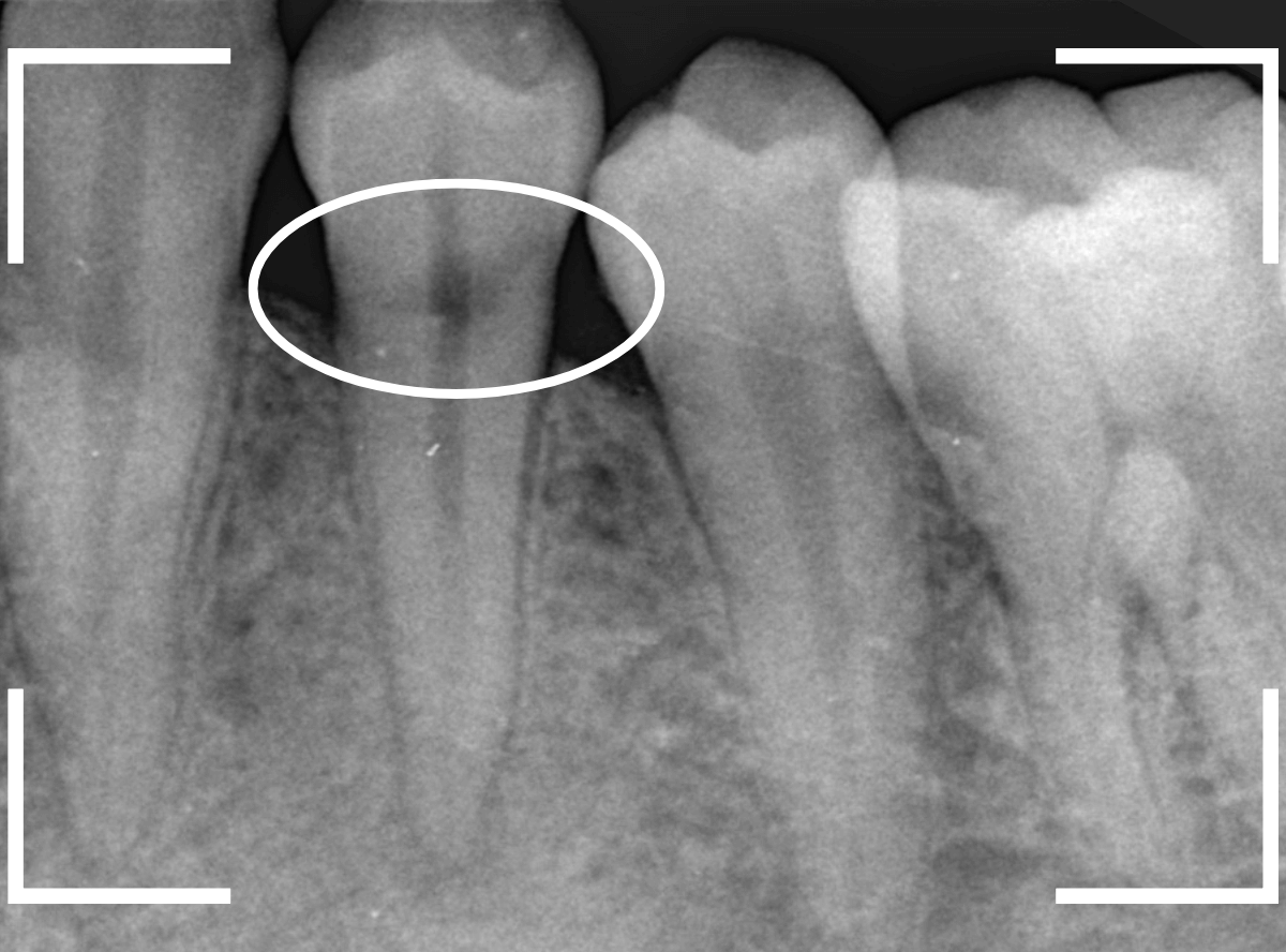 歯頚部う蝕の治療4