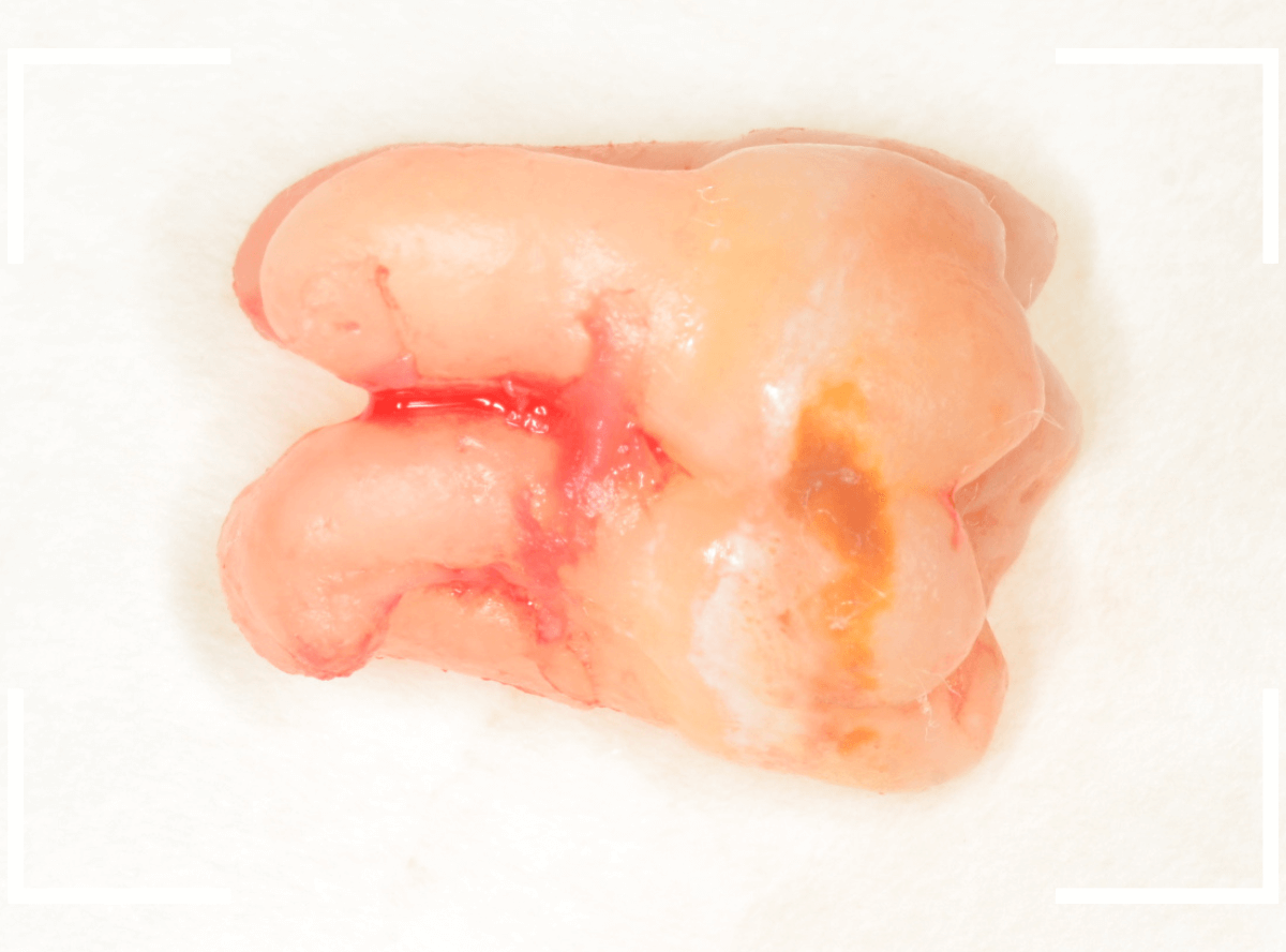 おやしらずの抜歯13-3