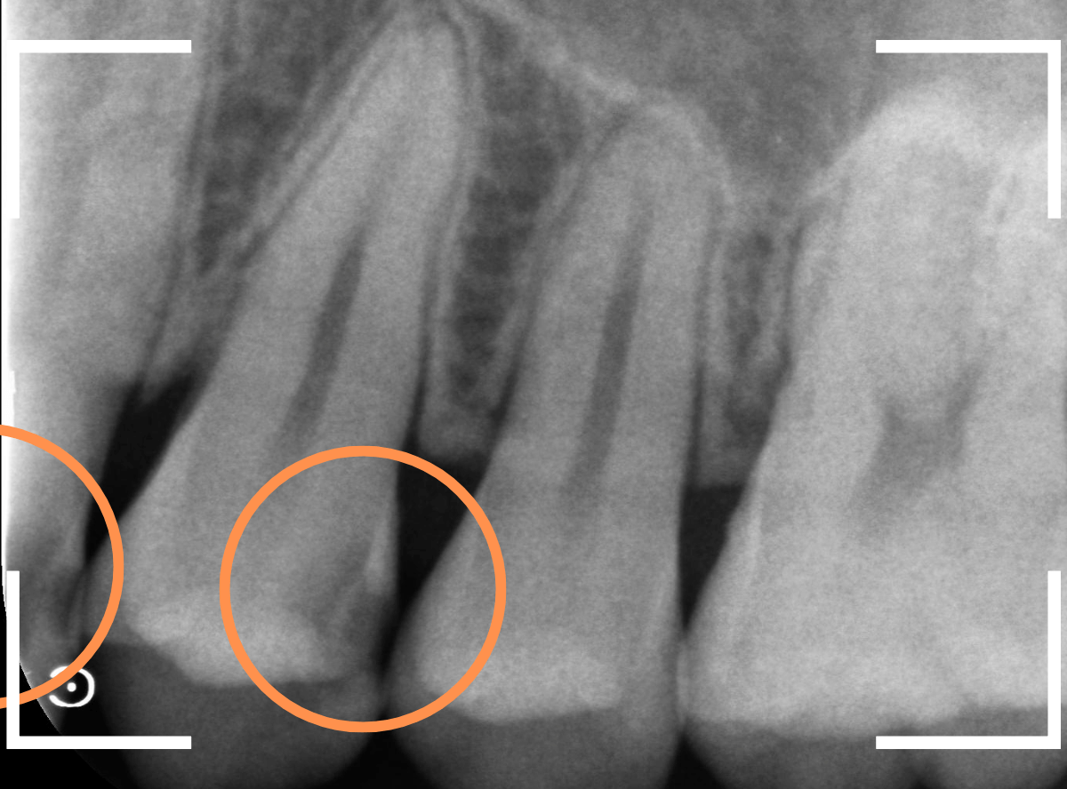 歯と歯の間の虫歯16-2