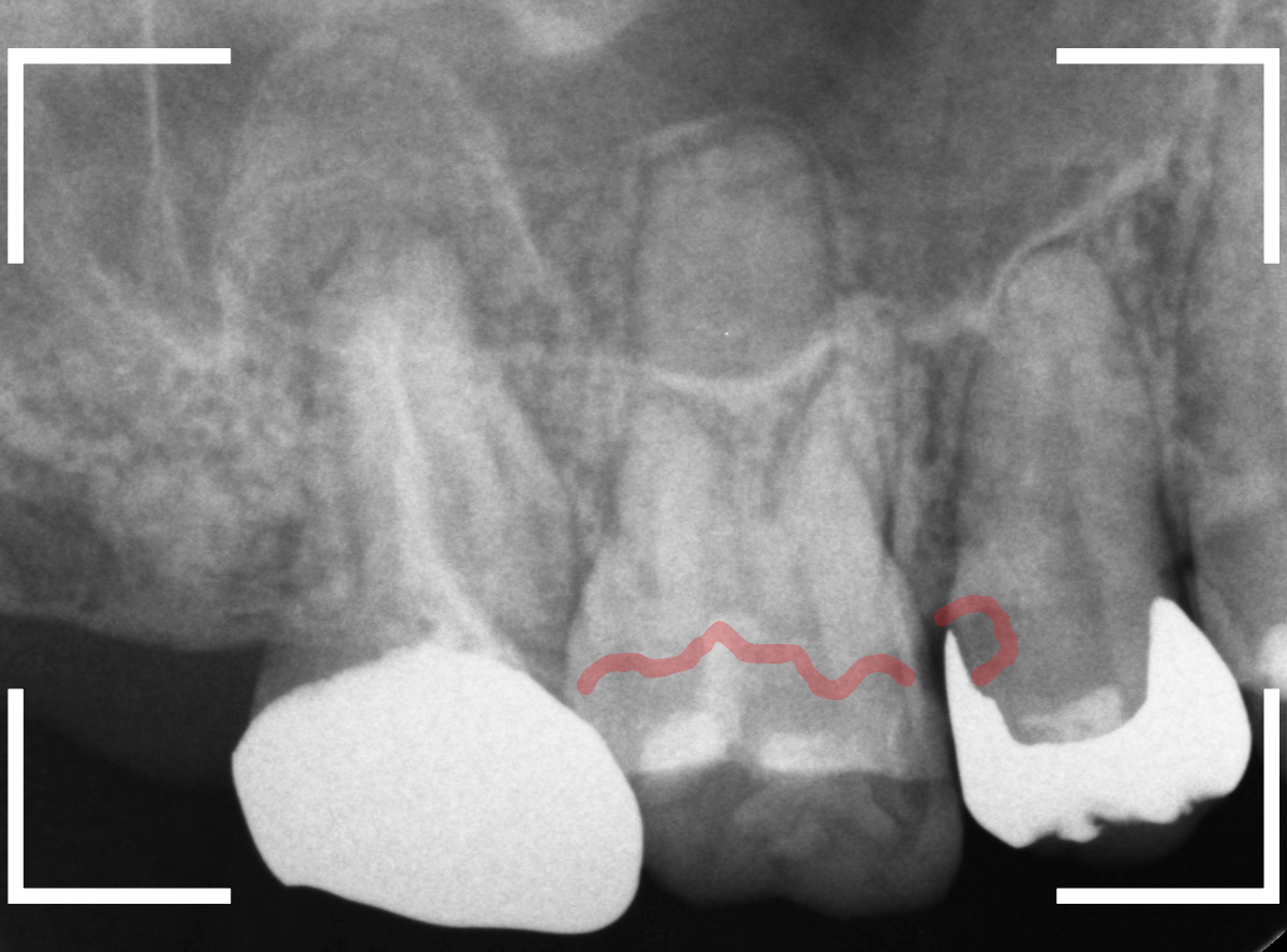 レントゲンでわかりづらい虫歯15-2