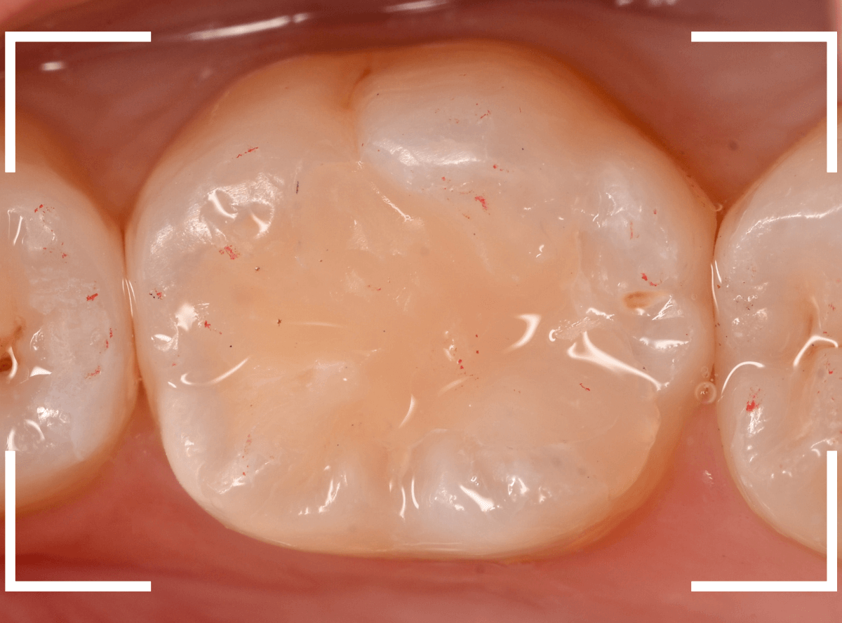 レントゲンでわかりづらい虫歯16-5