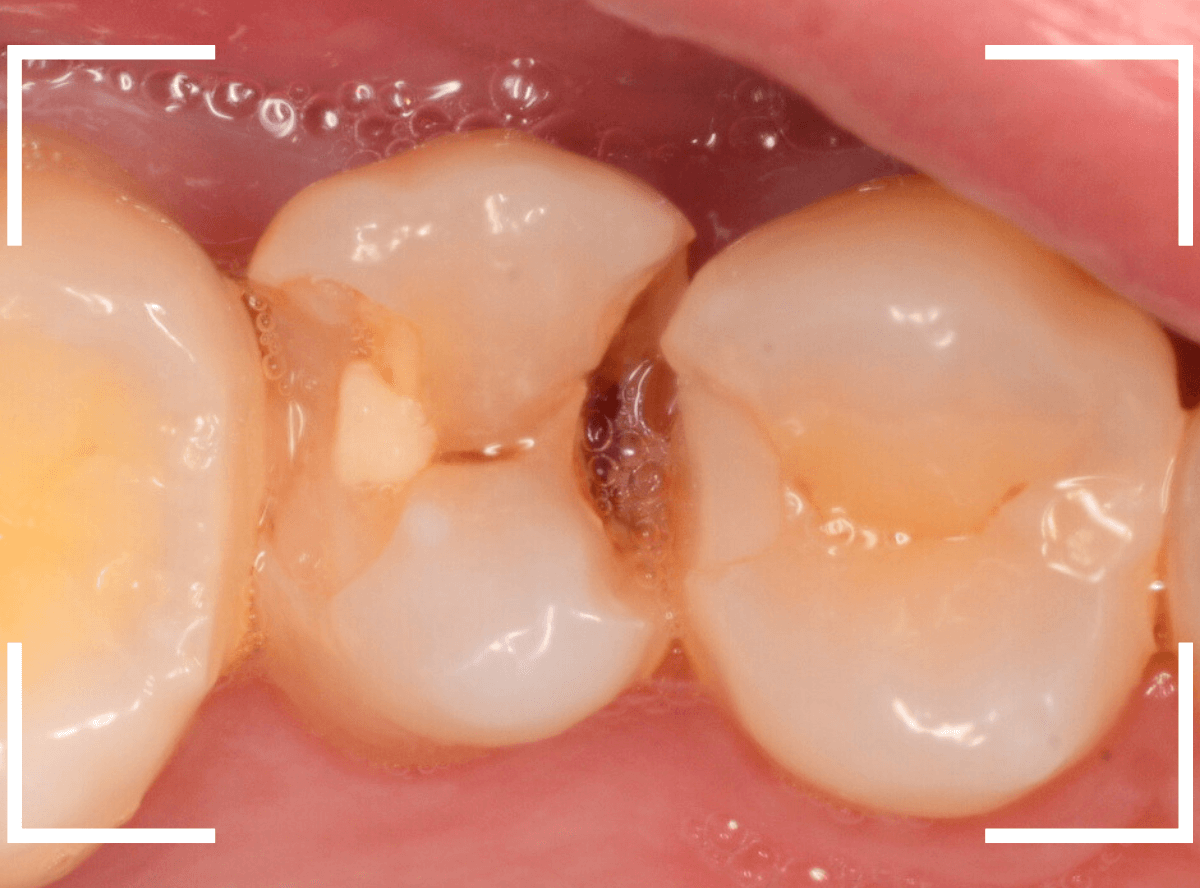気づかないうちに深い虫歯8-1