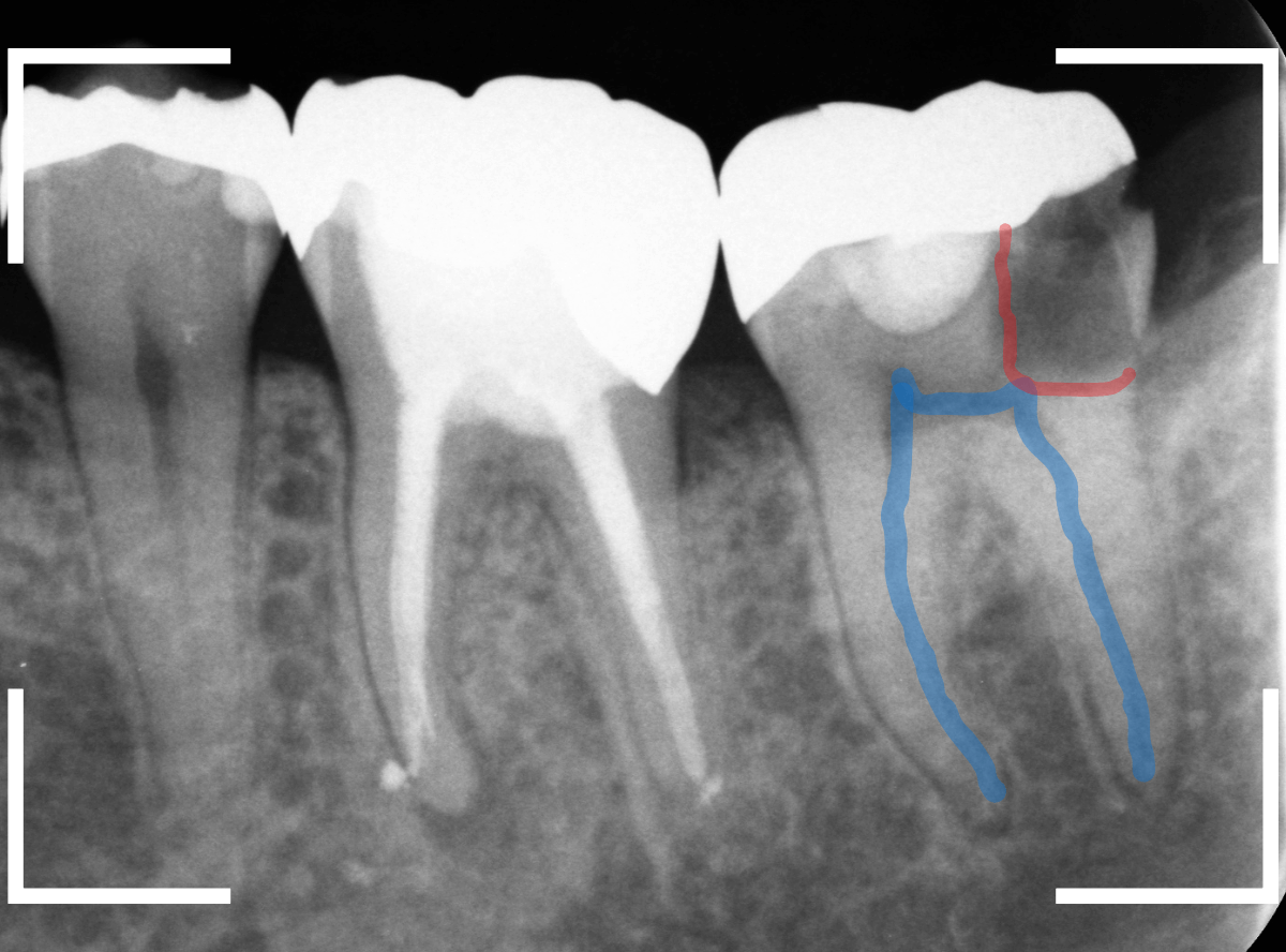 つめものの下の深い虫歯(画像)10-1