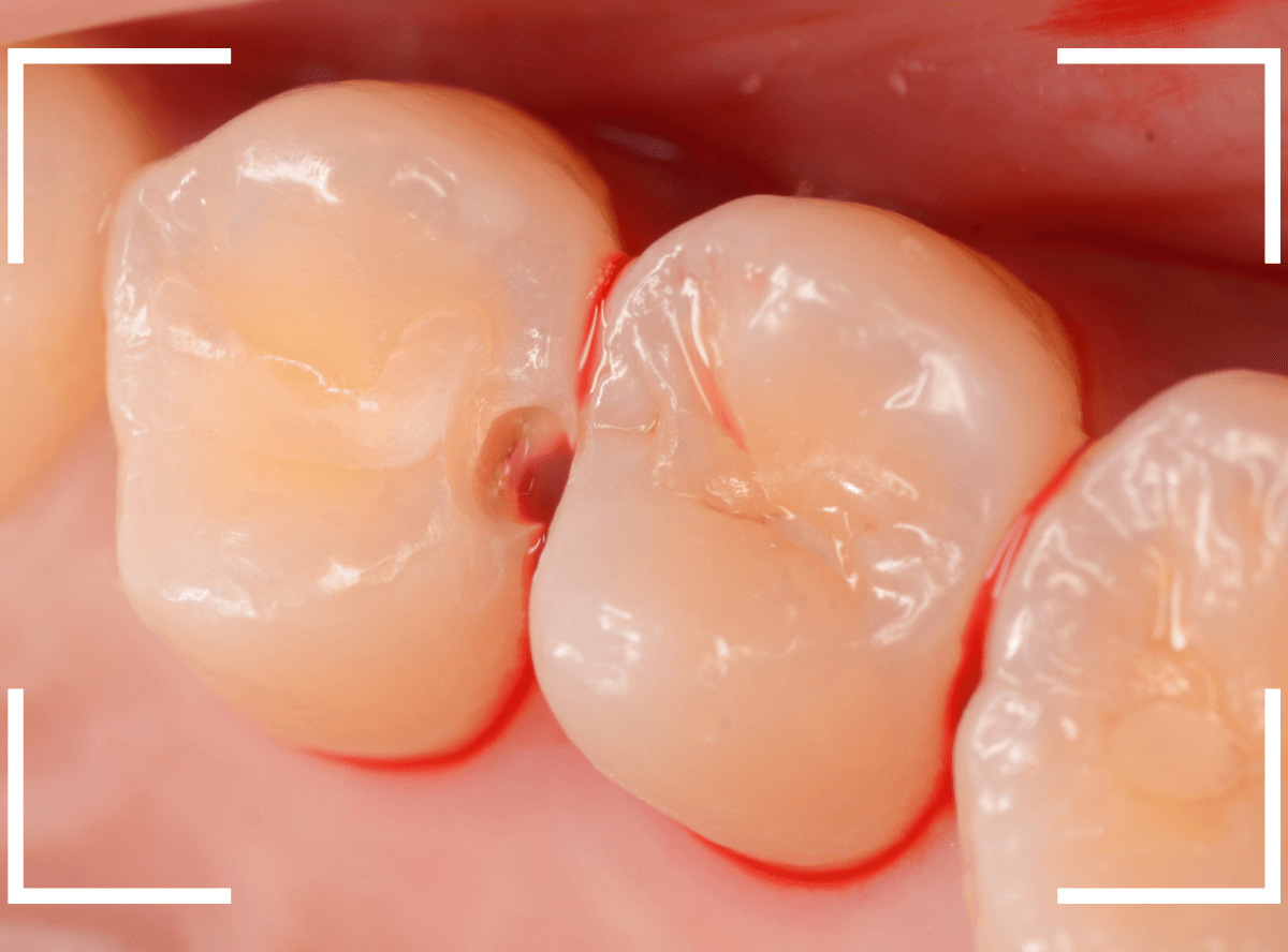 レントゲンでわかりづらい虫歯7-3