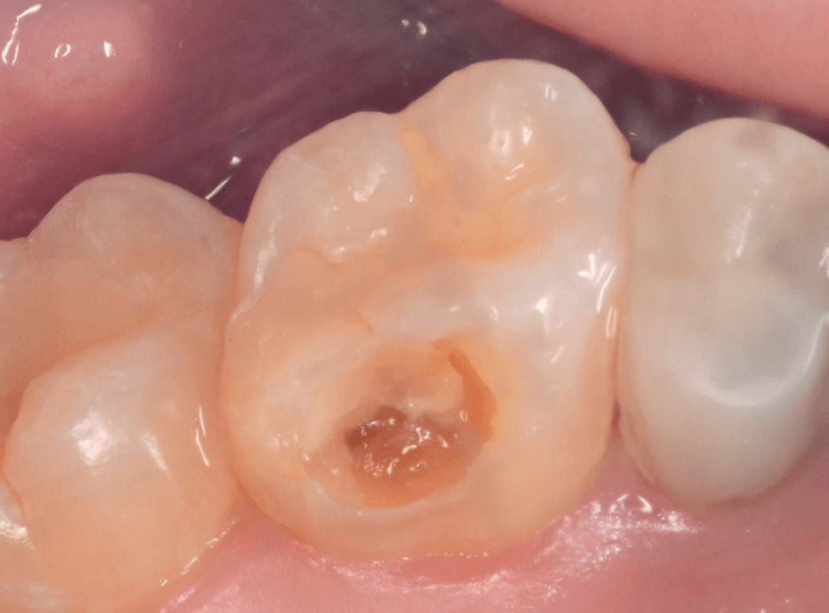 レントゲンでわかりづらい虫歯1-3