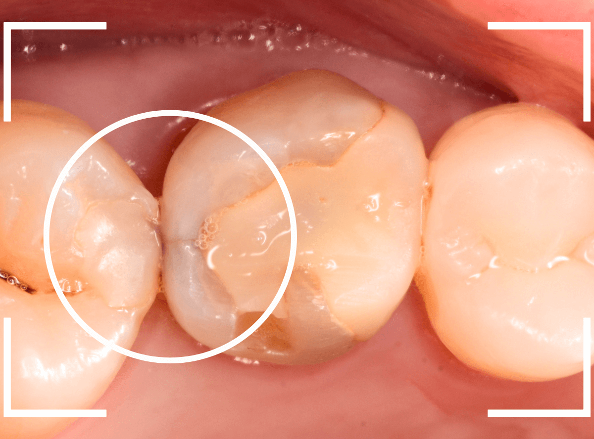 セラミック治療(インレー)35-1