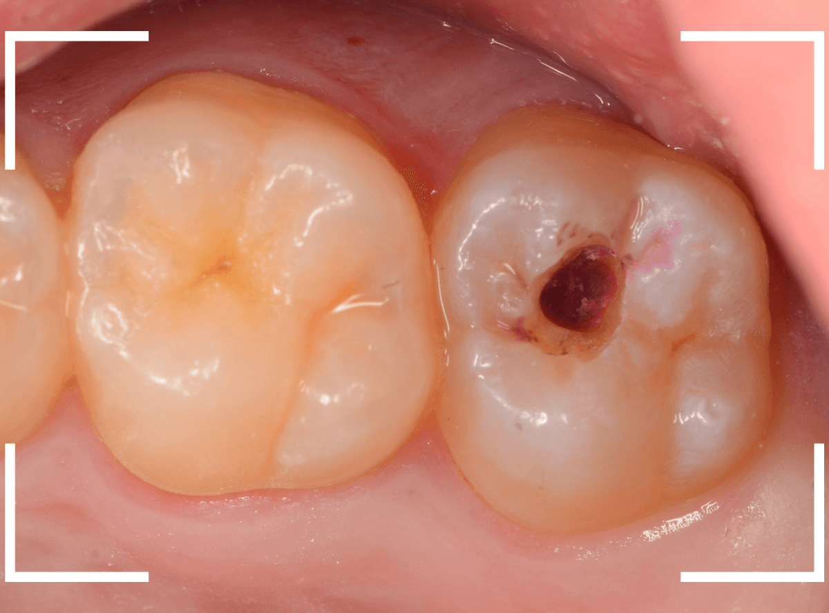 小窩裂溝う蝕4-3