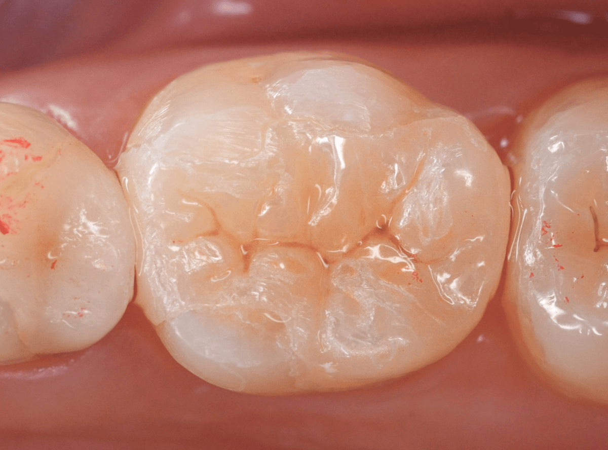 セラミック治療(インレー)12-4