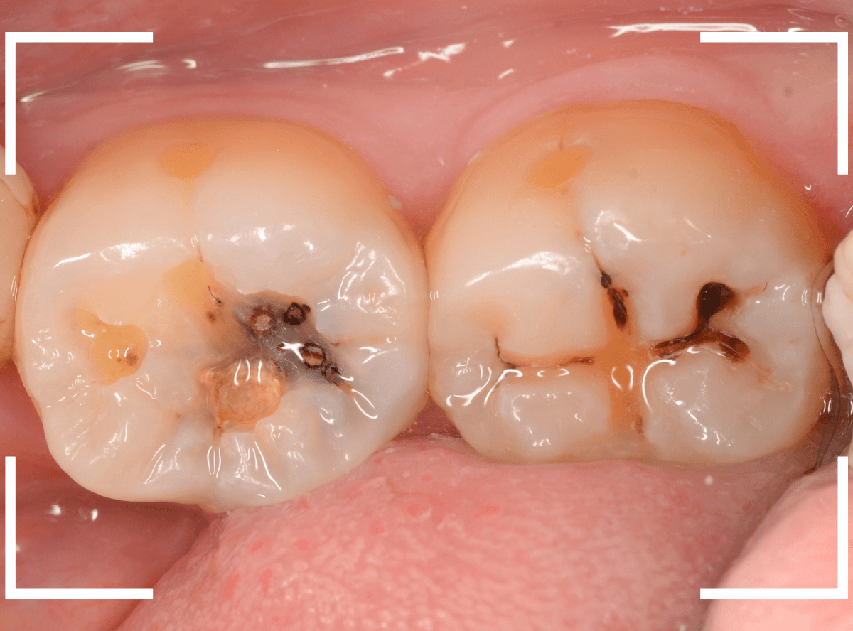 小窩裂溝う蝕2-3