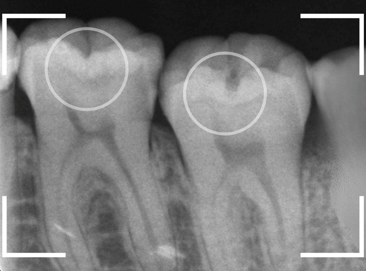 小窩裂溝う蝕2-2