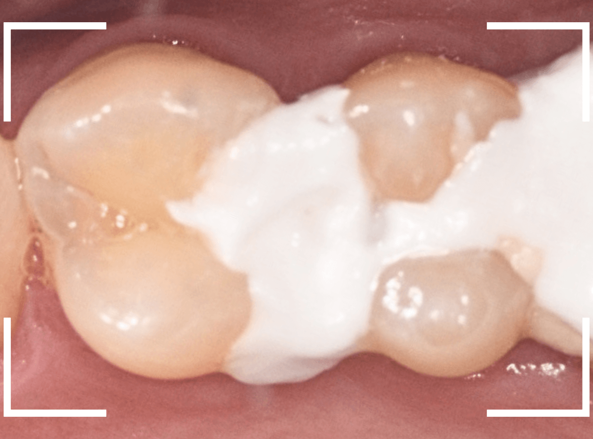 セラミック治療(インレー)21-1