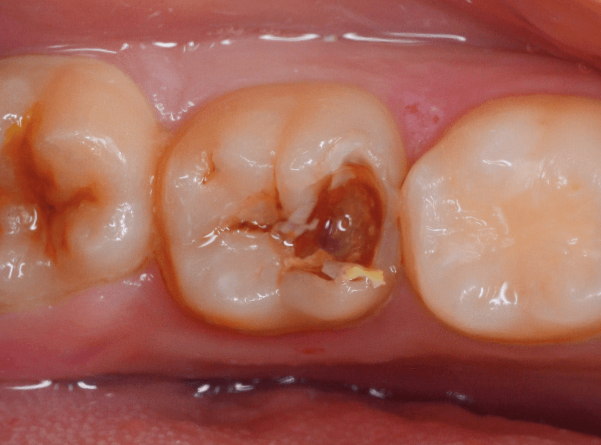 つめものの下の深い虫歯(画像)6-3
