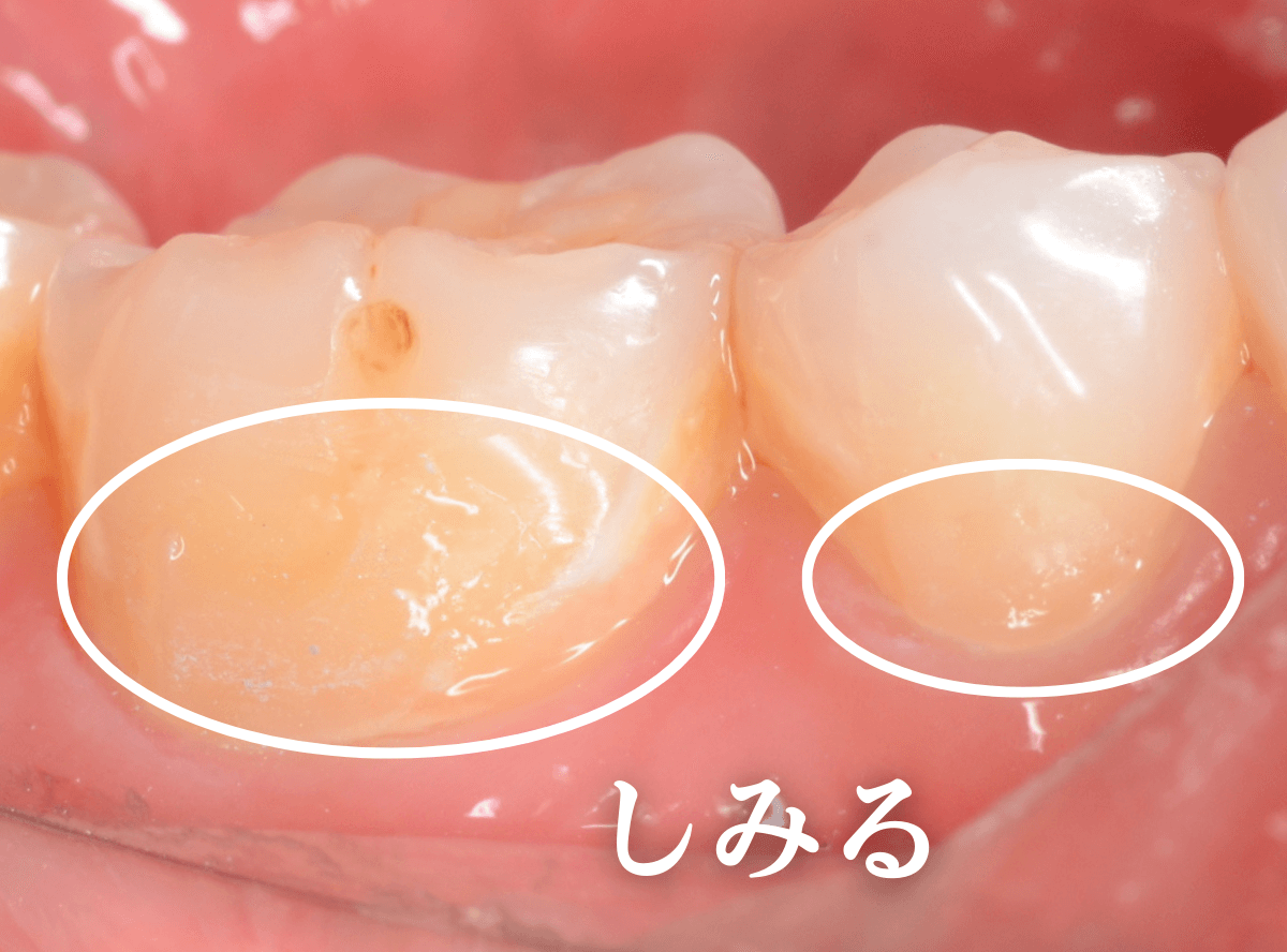 知覚過敏の画像1-1