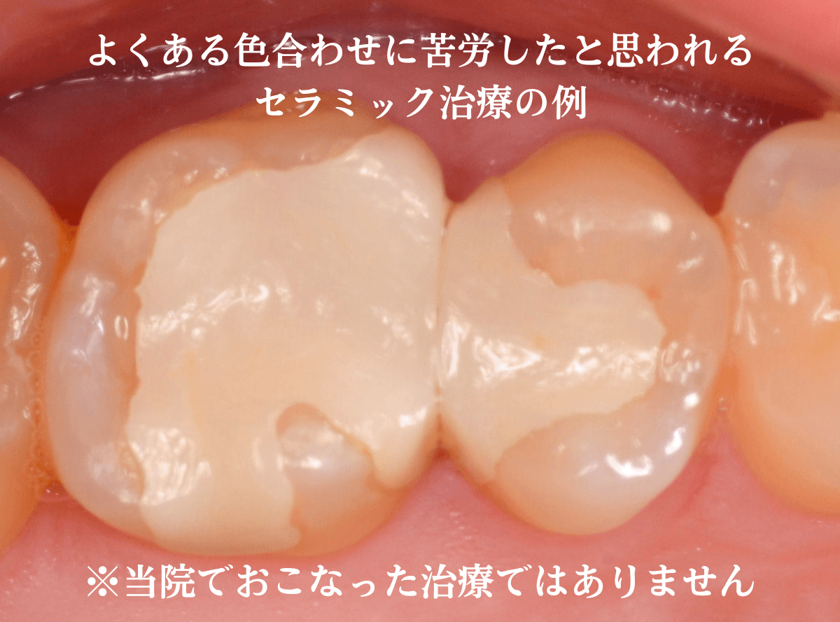 セラミック治療(インレー)2-4
