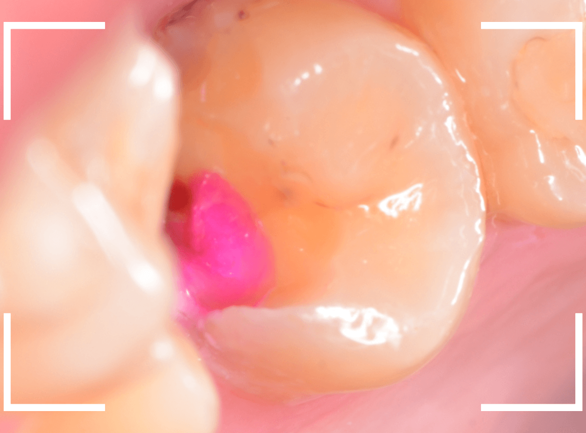 気づかないうちに深い虫歯3-5