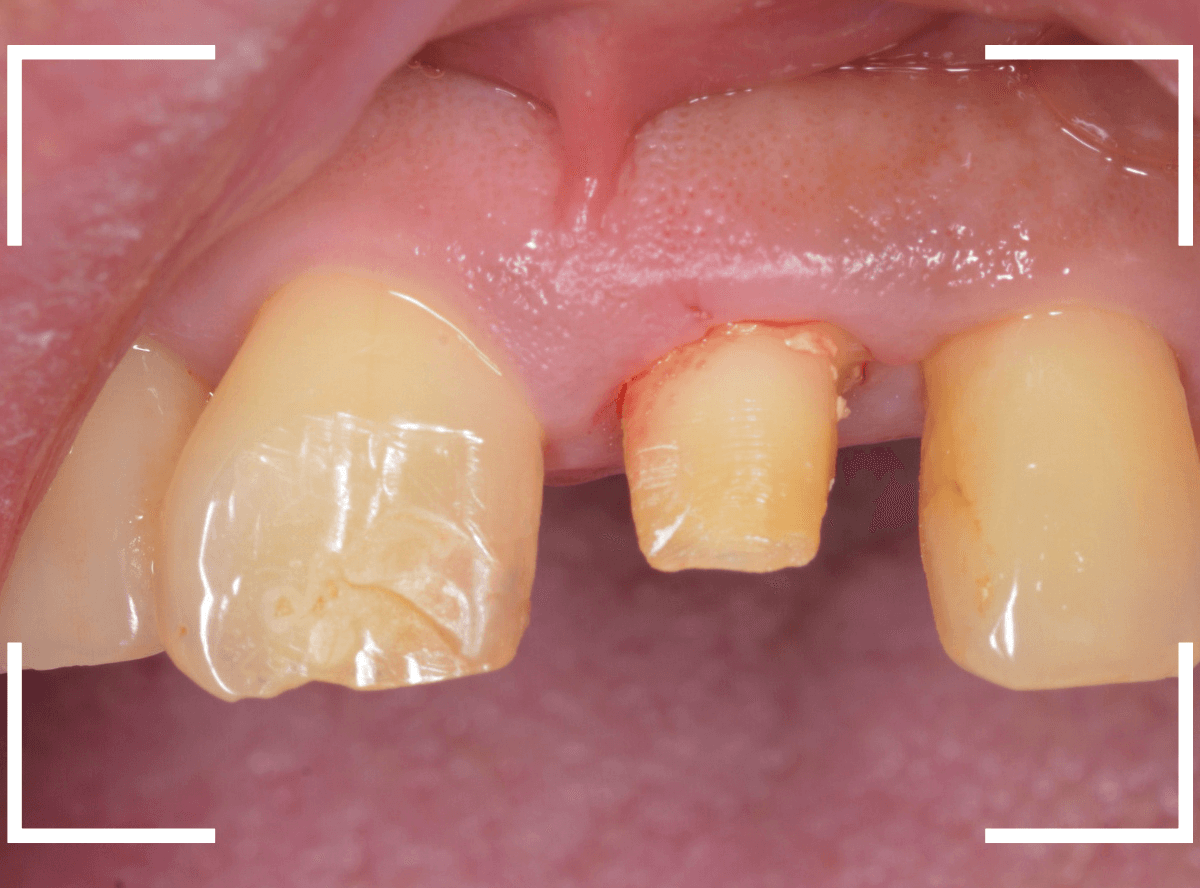 セラミック治療(前歯・クラウン)5-5