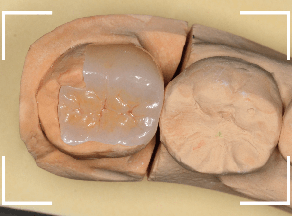 セラミック治療(インレー)20-3