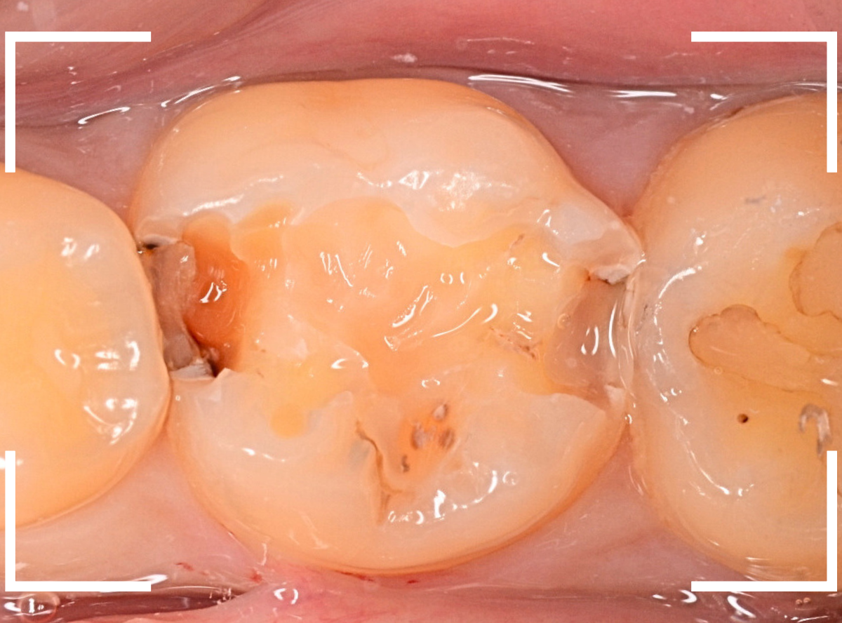 レントゲンでわかりづらい虫歯6-3