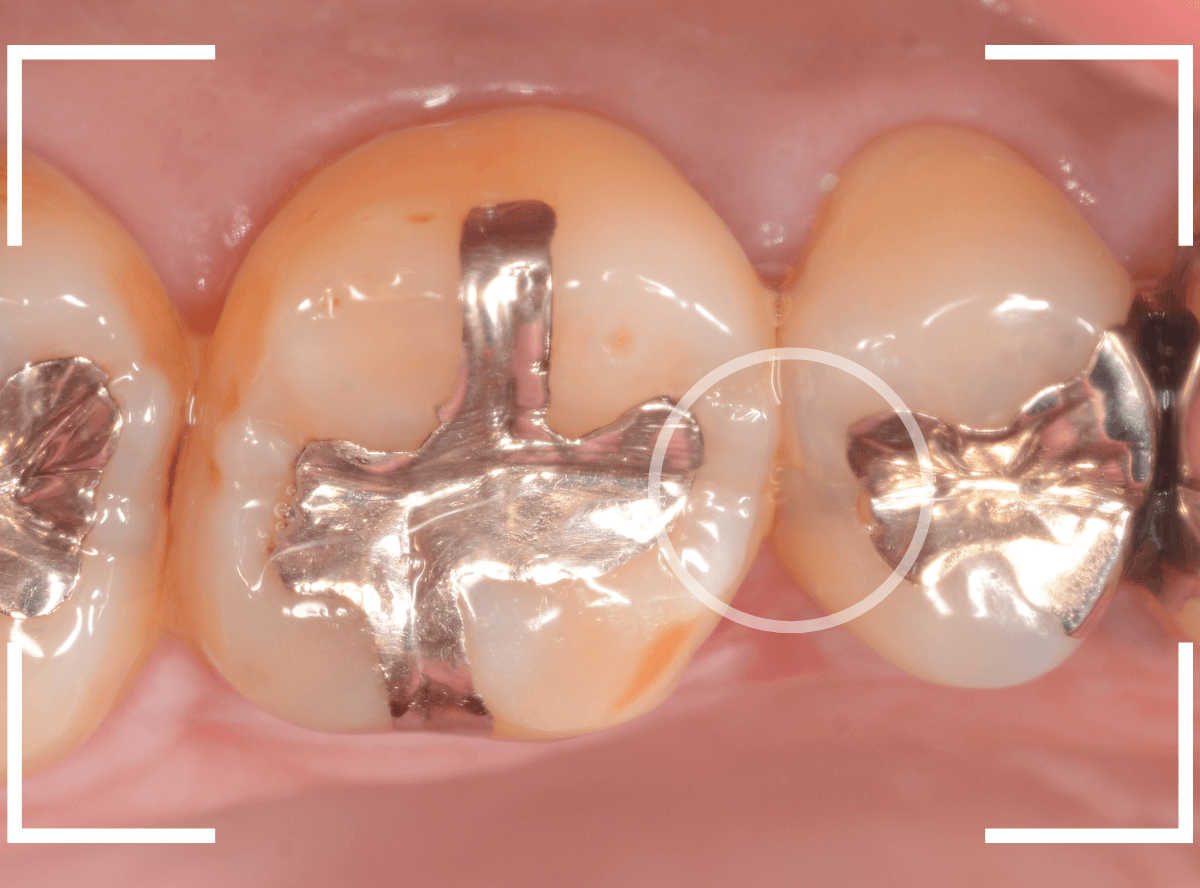 歯と歯の間の虫歯25-1