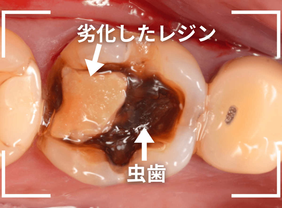 レントゲンでわかりづらい虫歯19-1