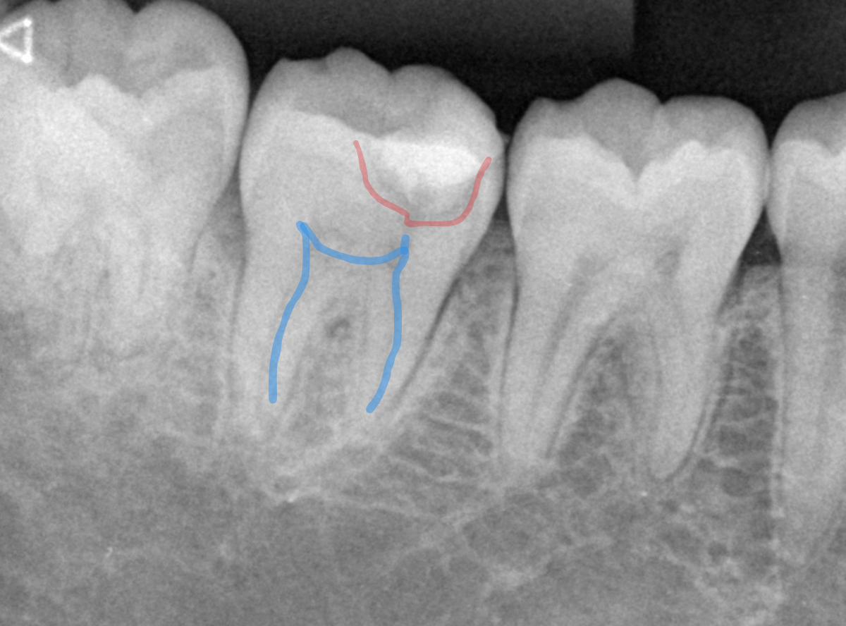 つめものの下の深い深い虫歯11-1