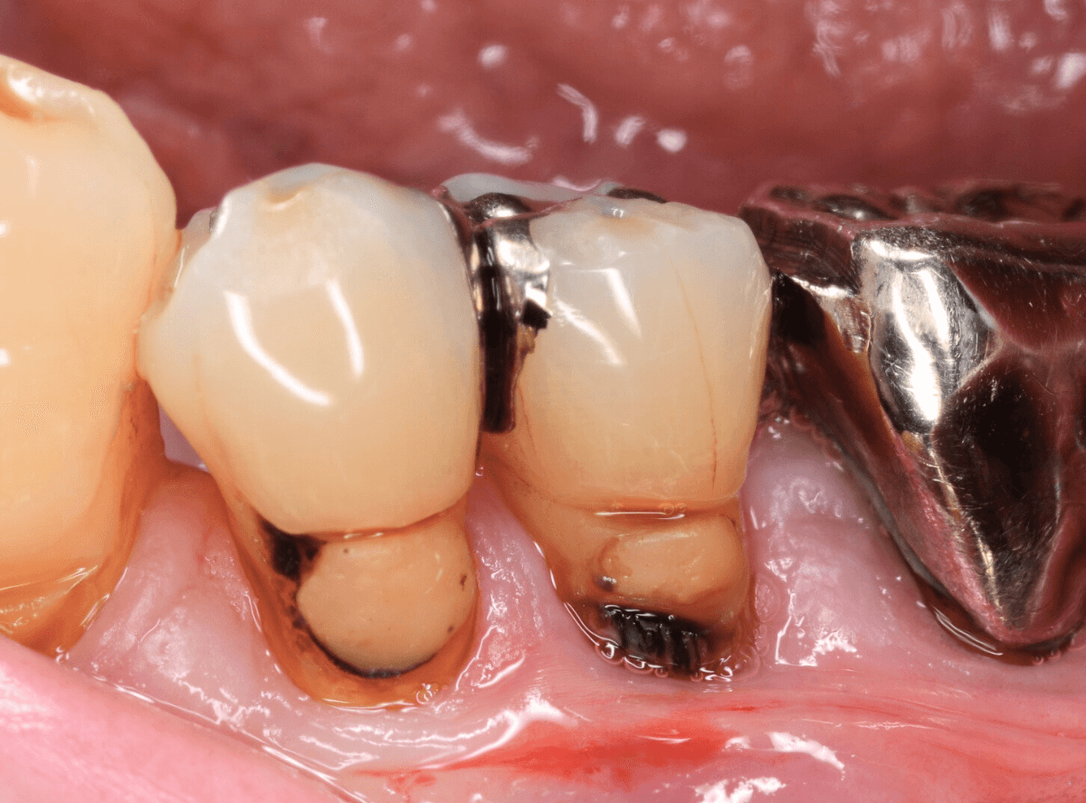 コンポジットレジン治療4-1