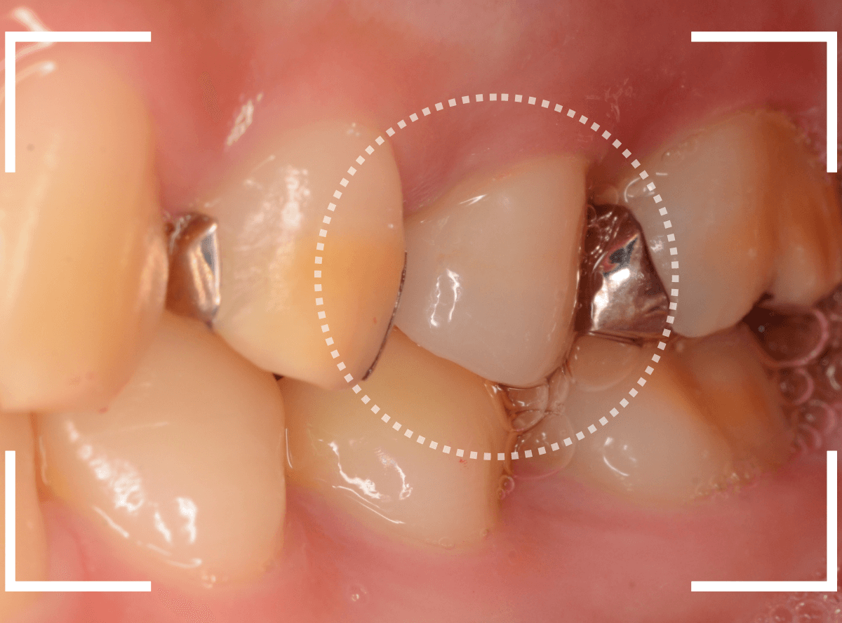 セラミック治療(クラウン・奥歯)13-5