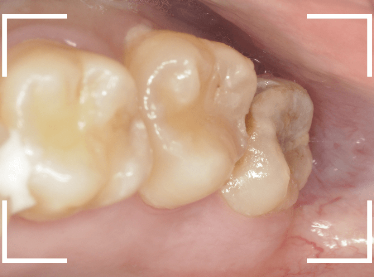 おやしらずの抜歯16-1