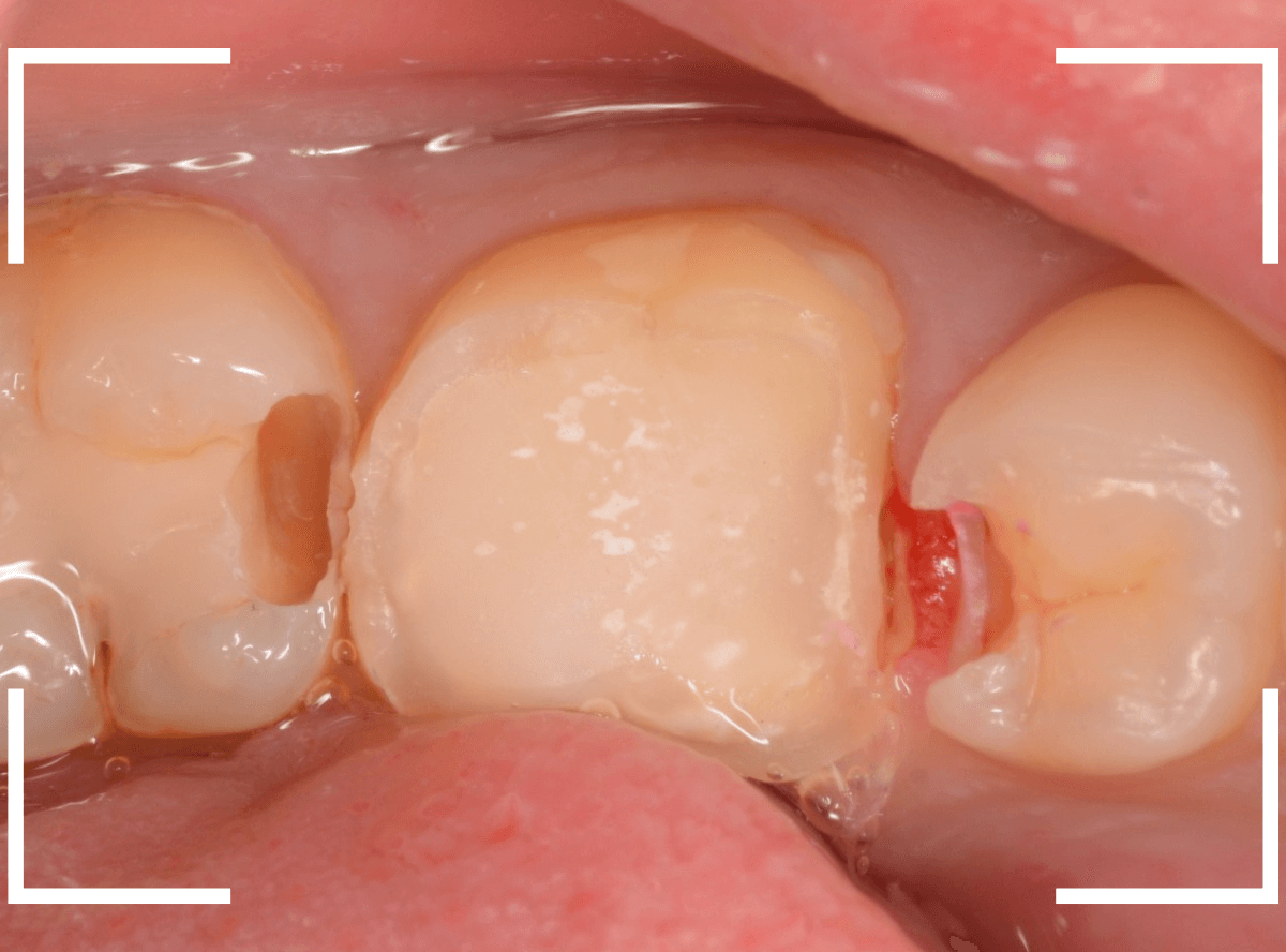 セラミック治療(クラウン・奥歯)9-2