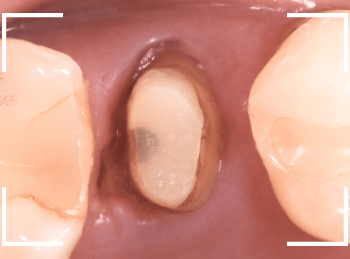 セラミック治療(クラウン・奥歯)8-6