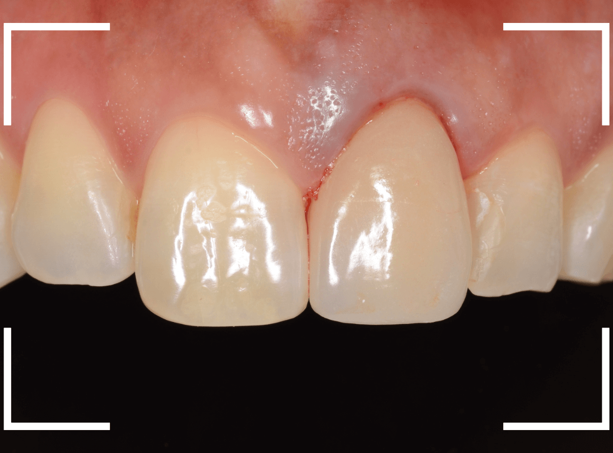 セラミック治療(前歯・クラウン)3-7
