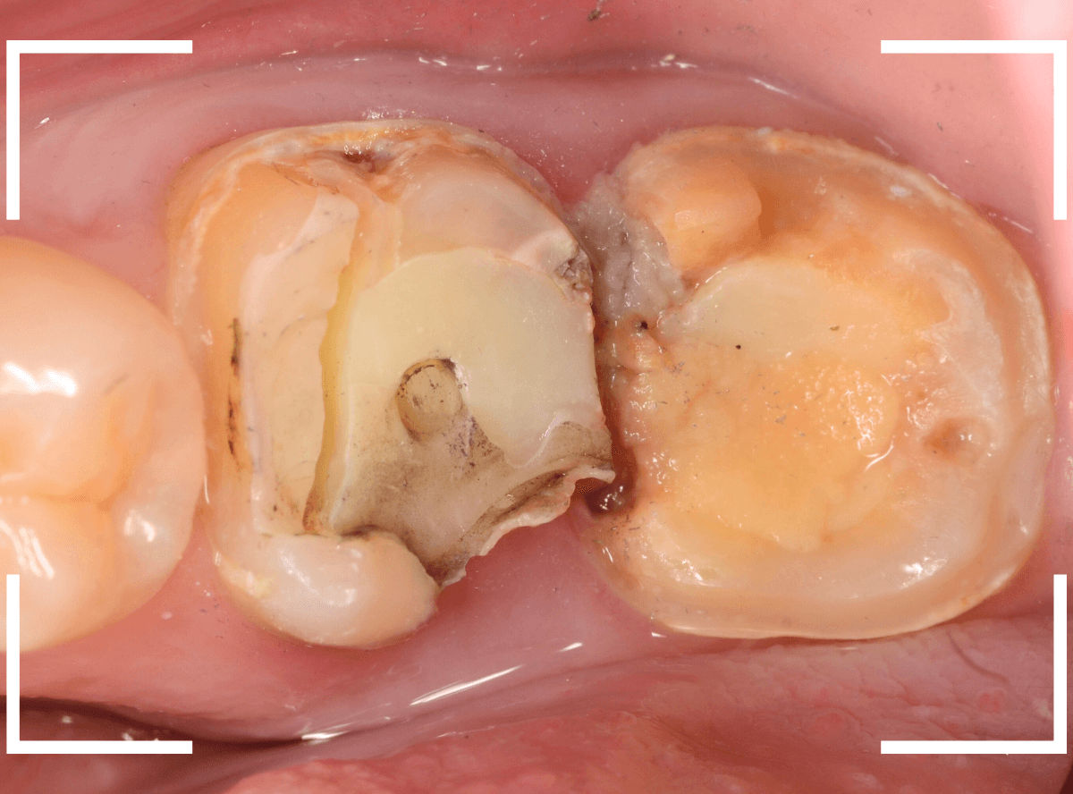 気づかないうちに深い虫歯15-3