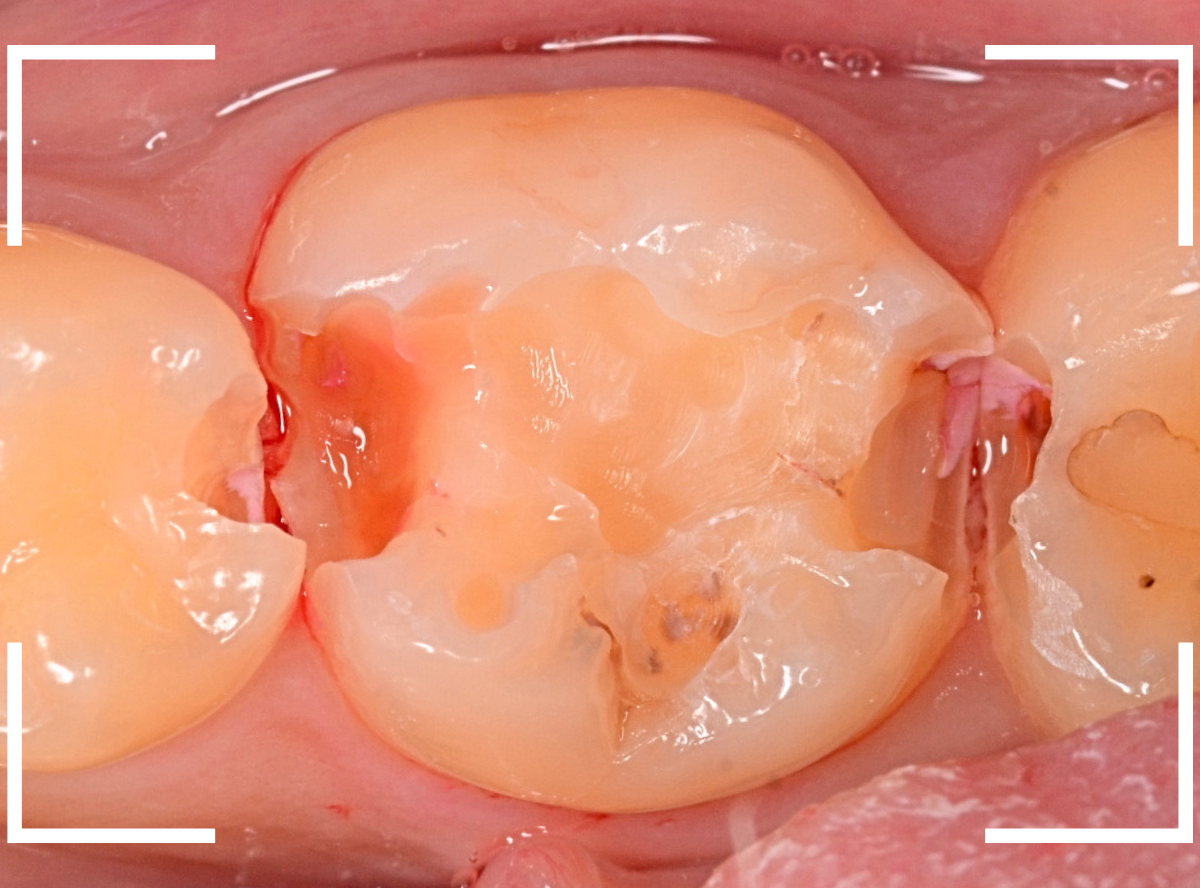 レントゲンでわかりづらい虫歯6-4