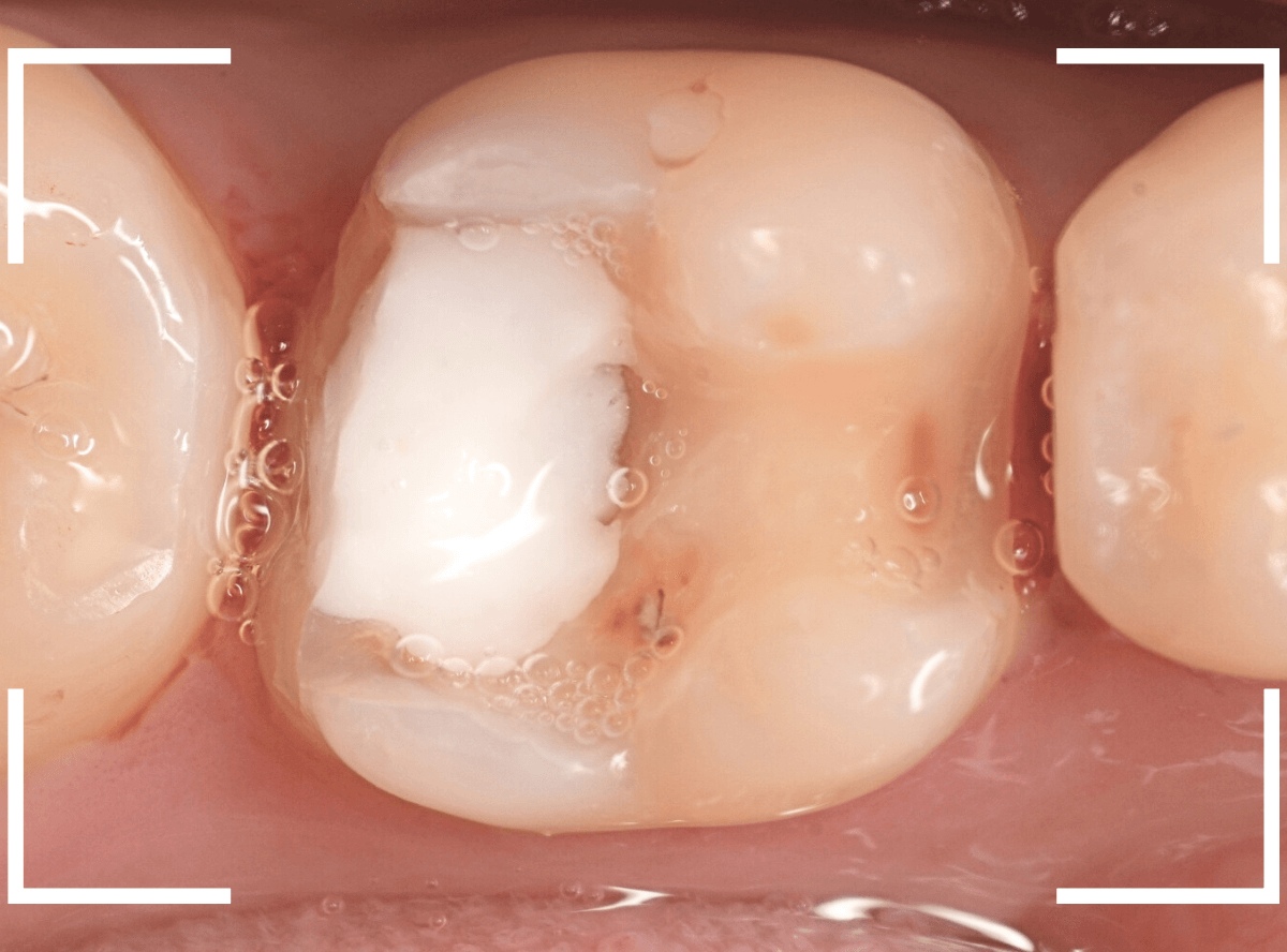 セラミック治療(インレー)29-2