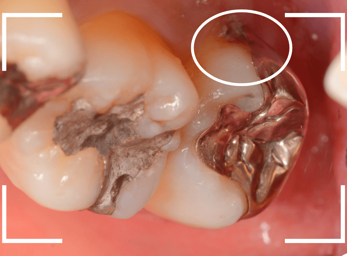 つめものの下の深い虫歯(画像)10-1