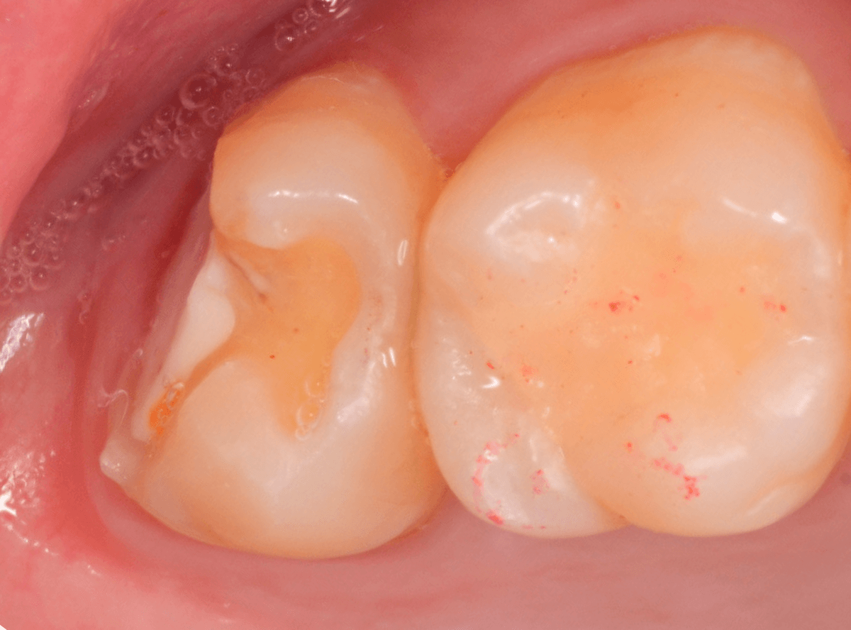 気づかないうちに深い虫歯1-7