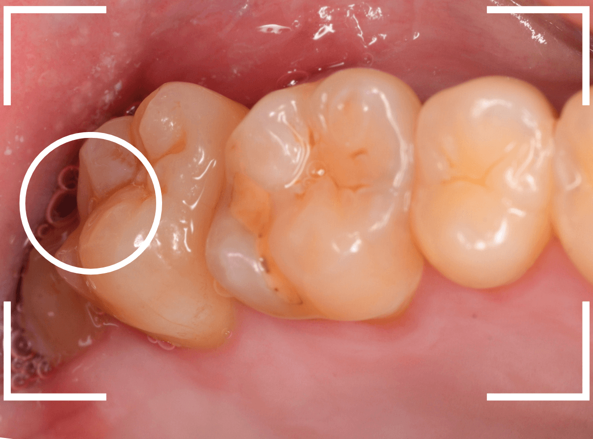 おやしらずの抜歯11-2