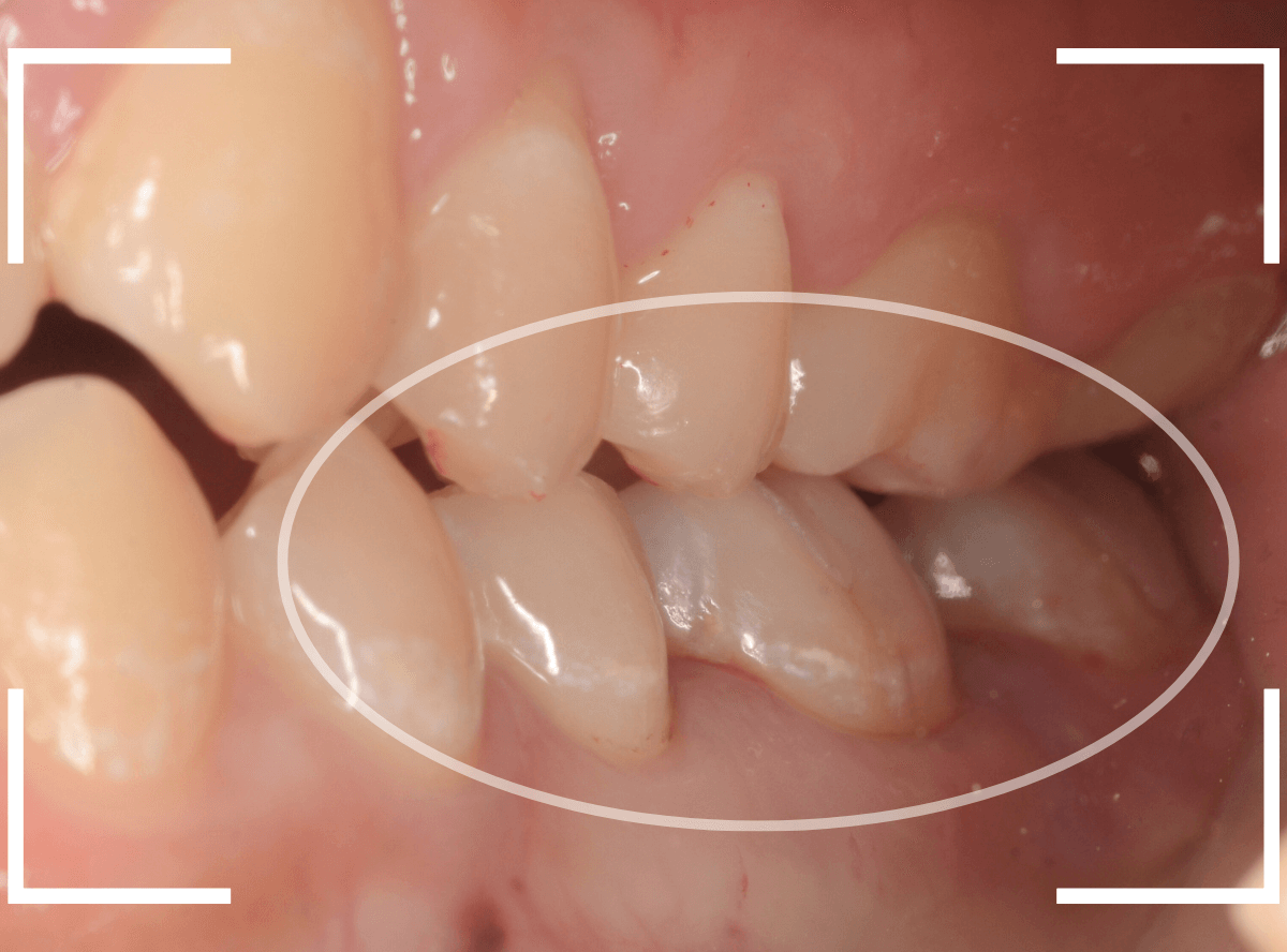 セラミック治療(インレー)30-7