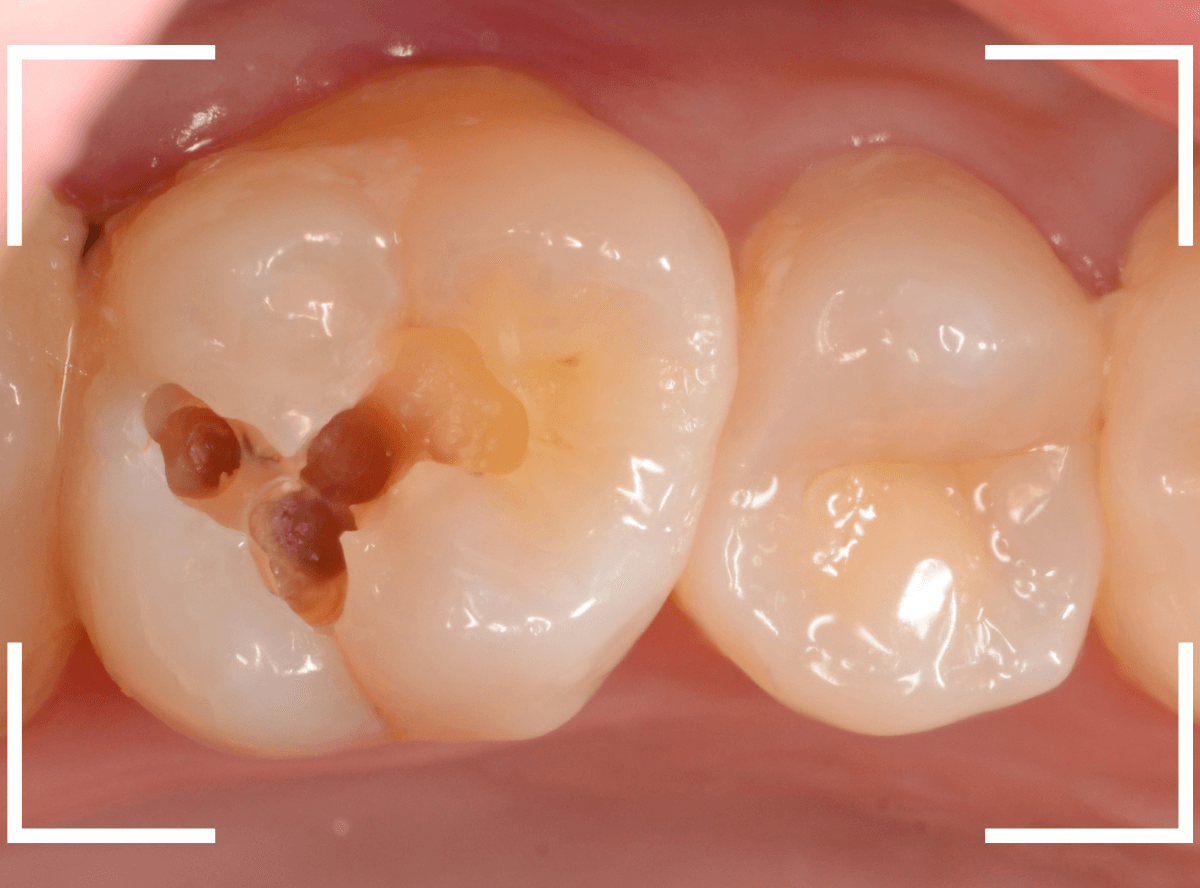 セラミック治療(インレー)32-3