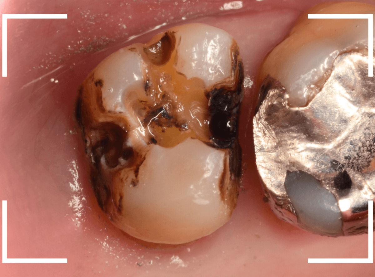 つめものの下の深い虫歯(画像)10-1