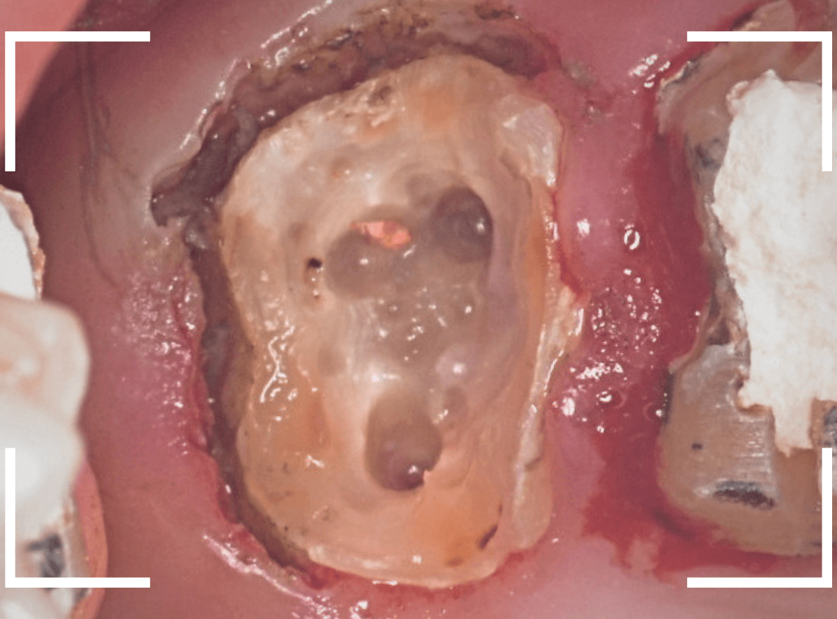 歯の土台の再治療2-3