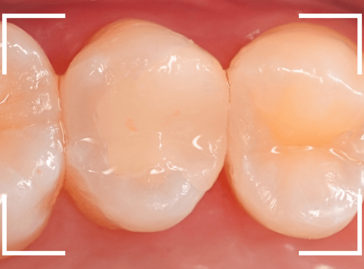 セラミック治療(インレー)27-8