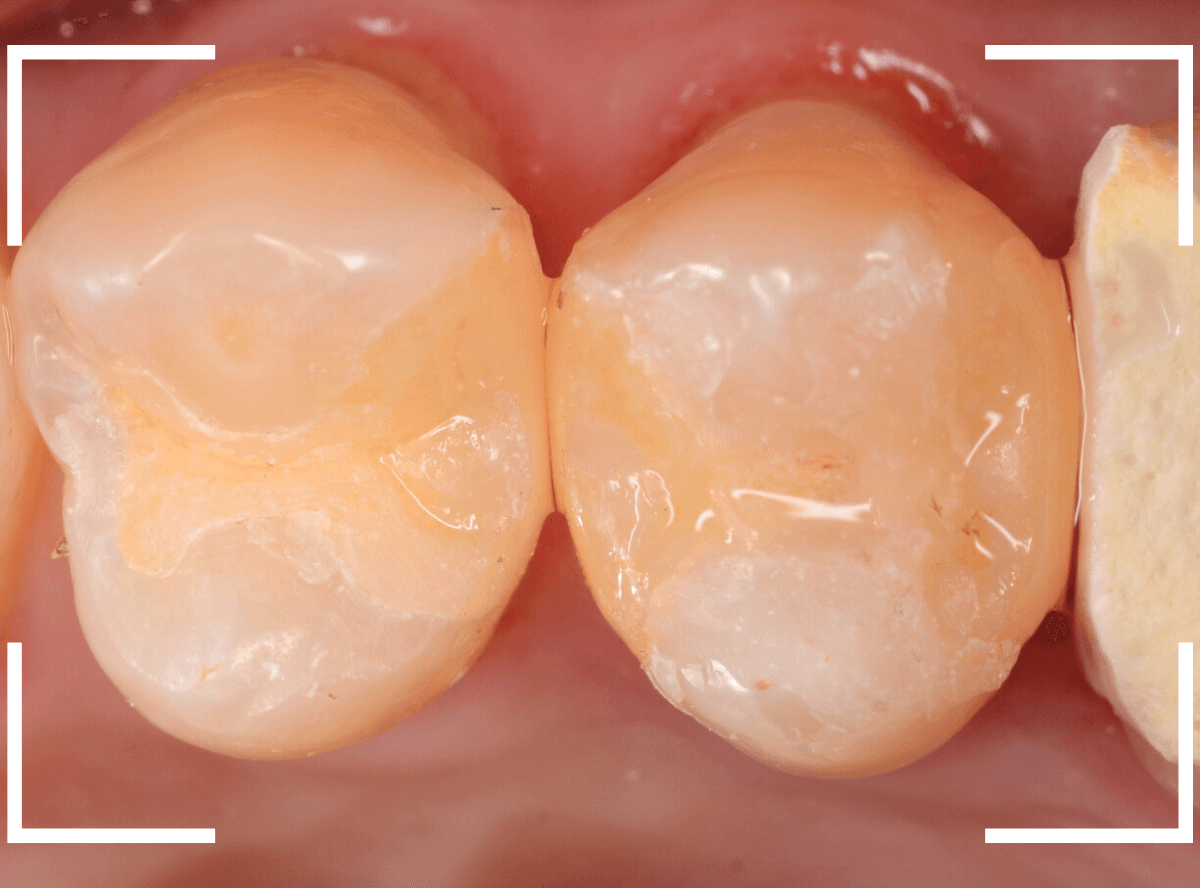 セラミック治療(インレー)21-4