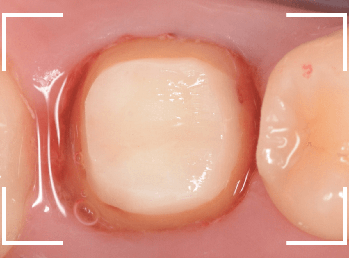 セラミック治療(クラウン・奥歯)15-2