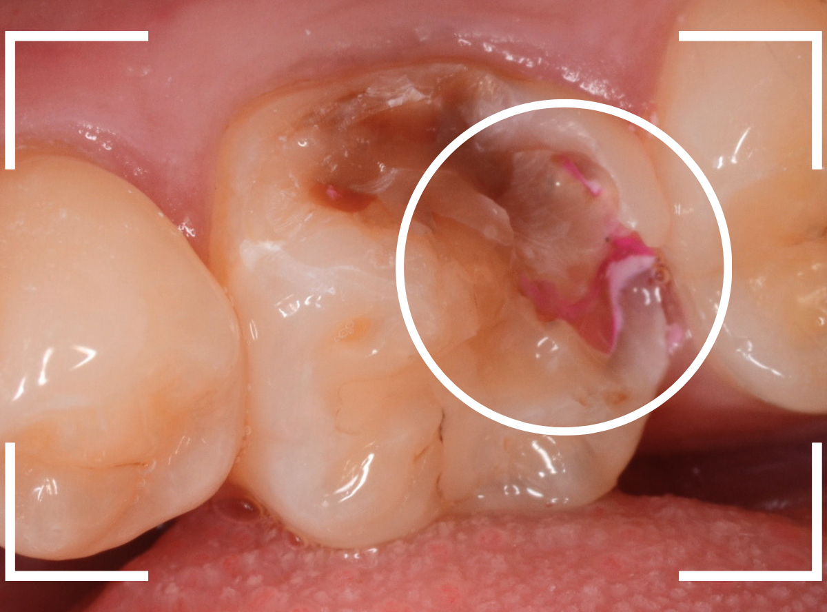 つめものの下の深い深い虫歯11-3