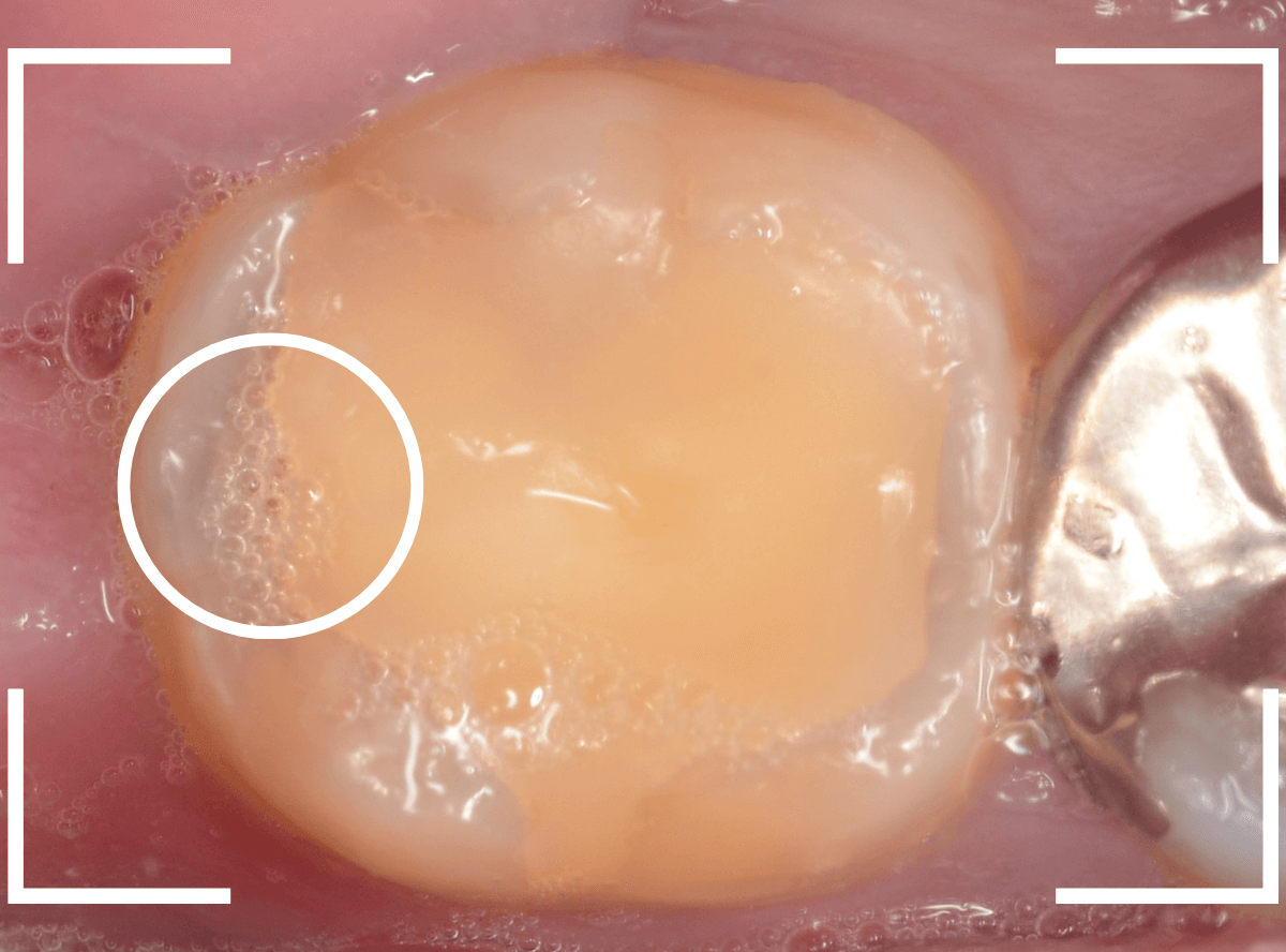 気づかないうちに深い虫歯13-1